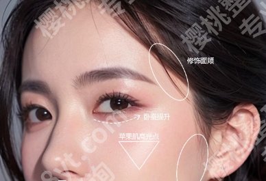 上海九院颧骨内推加下颌角一共多少钱？颧骨内推整形案例揭晓