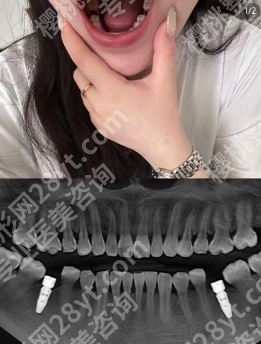 广州圣贝口腔种牙质量怎么样？详细介绍来袭