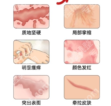 激光祛疤真实效果图片？激光祛疤后需要冰敷吗？