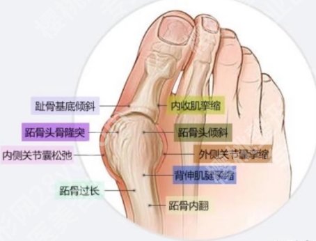 陈圣英医生大脚骨做得怎么样？圣嘉新专家实力测评！
