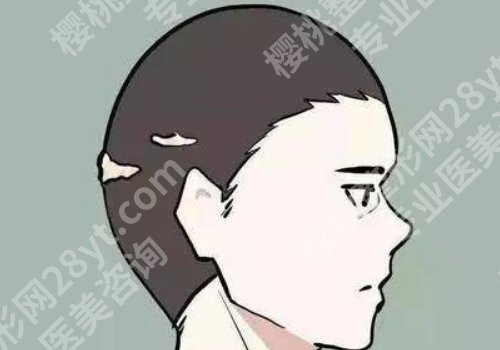 兰大二院可以植发吗？科室简介及25年价格表更新！