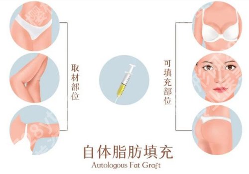 北京八大处脂肪填充怎么样？顾客口碑曝光！好评连连 ！