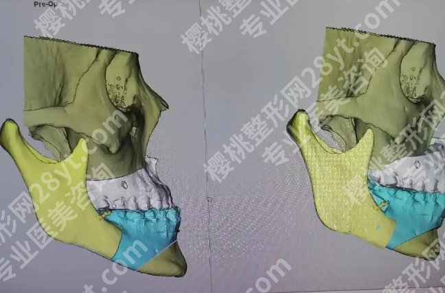 首口颏成型张凯宇怎么样?实操案例曝光!