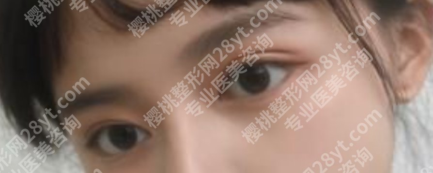 浙一做双眼皮要多少钱？眼部项目科普！
