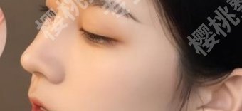 深圳北大医院隆鼻价格贵不贵？何君君vs李天石技术对比！