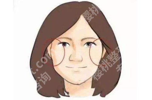 北京张笑天颧骨内推怎么样？医生介绍及案例更新！