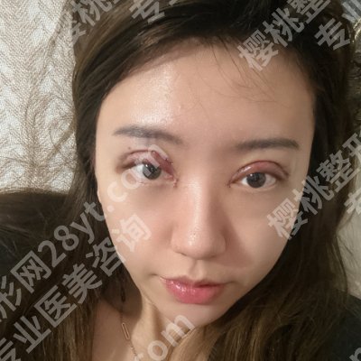 北京黄久佐双眼皮失败修复案例更新！技术大牛、真实网友反馈！