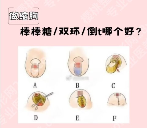 上海华山医院缩胸手术费用贵不贵？2025收费标准一览！