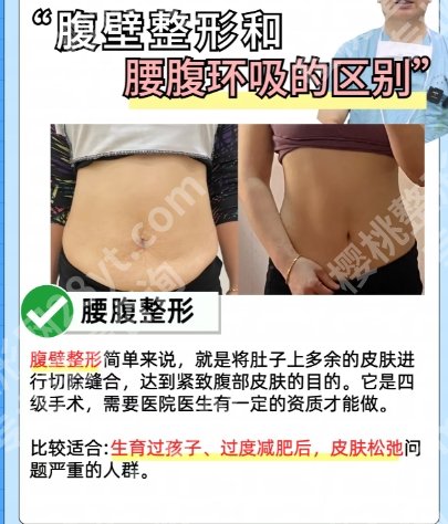 上海九院腹壁整形多少钱？腹壁整形案例曝光！