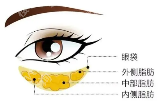 北医三院丰胸手术多少钱？自体脂肪隆胸26821元左右