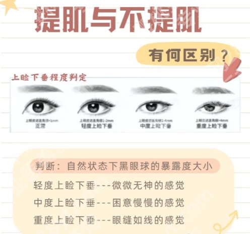 陈三群双眼皮案例！医生技术优势剖析！就诊必看！