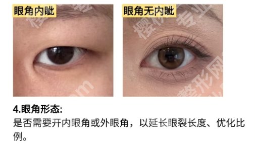 孙好杰双眼皮案例！热心网友反馈来袭！速速码住！