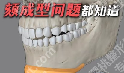 首口颏成型费用贵不贵？全新收费标准更新！戳进来看