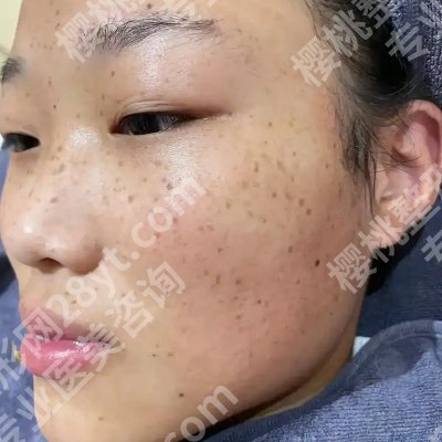 湘潭中心医院点阵激光多少钱一次？低至4000元起！附真实案例！
