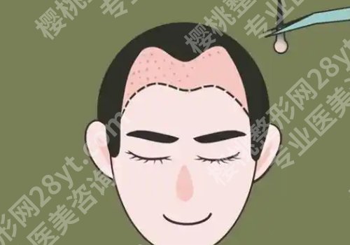 医学科学院整形外科医院植发费用是多少？低至10000元起！附优势信息！