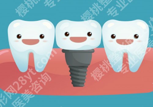 北京协和医院种植牙价格是多少？低至10000元起！内附新版价格表！