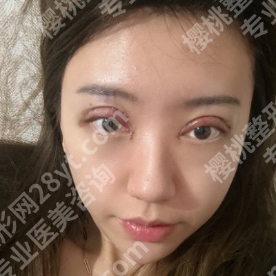 邯郸第三医院割双眼皮怎么样？附医院资料、双眼皮案例！