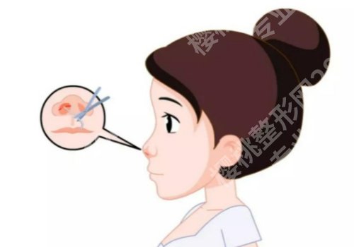王先成医生鼻子怎么样？医生详情、案例一键查看！