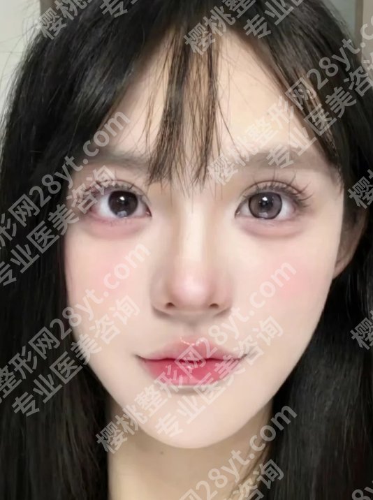 袁斯明医生双眼皮做的怎么样？医生技术测评！附25年价格