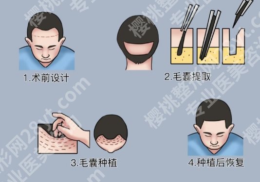 绍兴植发价格贵不贵？推荐几家口碑好又实惠的医院！