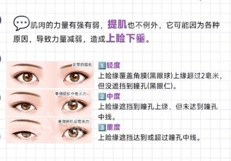 南通割双眼皮哪个医生好？祁俊、姚晓东、姜云等风格挺自然的~