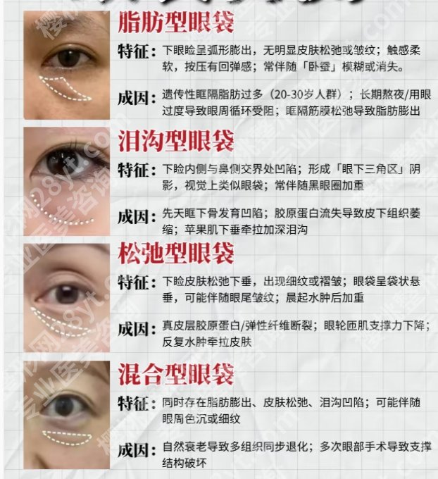 深圳北大医院眼袋多少钱一次?人气医生信息盘点|案例