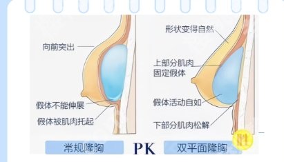 广州朱云医生隆胸怎么样？真人面诊过程分享！见证美丽蜕变！