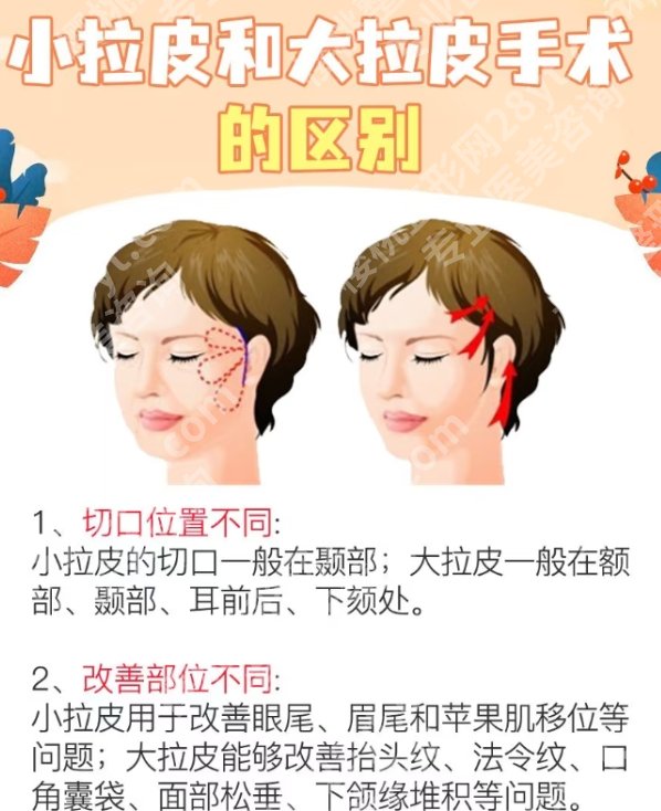 协和拉皮手术做的好吗？拉皮手术案例曝光！