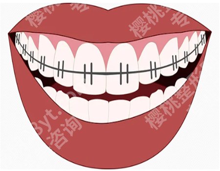 宁波第六医院牙齿矫正价格多少?龅牙矫正13000元起