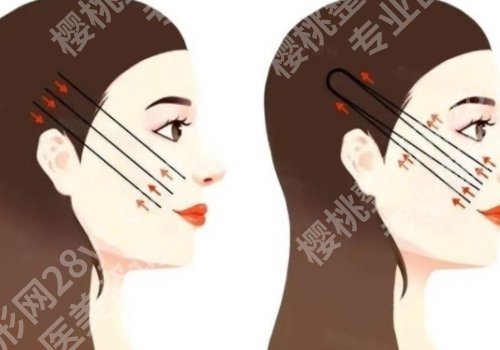 陈文才医生微创筋膜提升怎么样？医生资料、擅长项目详情一览！