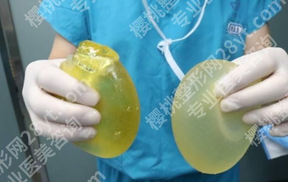 北京八大处假体隆胸取出价格25年更新，技术优势_真人案例曝光！