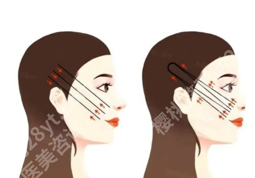 季滢医生筋膜提升怎么样？技术实力在线！优势公布！