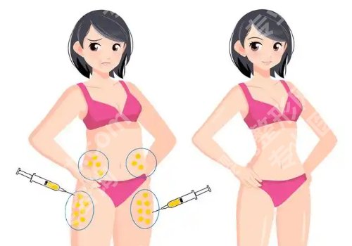 上海彭才学抽脂怎么样？实力出众、附案例！