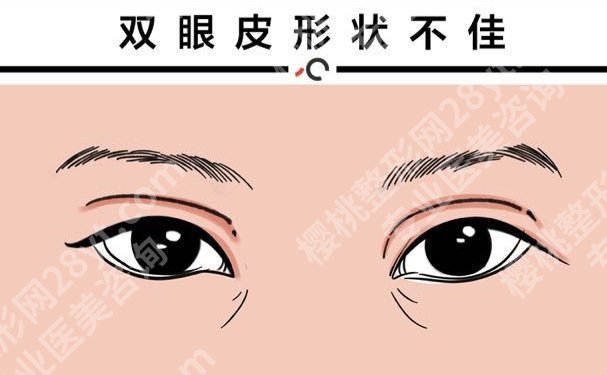 东莞人民医院做双眼皮多少钱?价格大概是7980元起