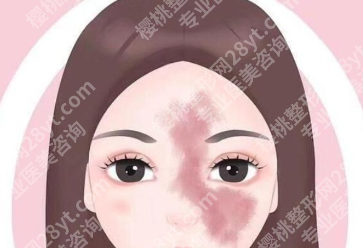 赵茹医生看胎记怎么样？真实的案例鉴赏！