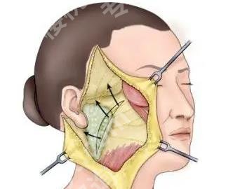 广州王世虎拉皮怎么样？戳进来看真实的口碑点评！术后小tips