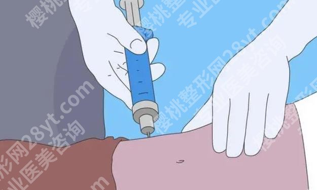 成都李烈吸脂案例图曝光！吸脂手术前后小贴士分享！