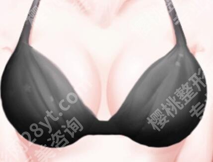 冯传波做胸有边缘感吗？近期案例反馈，价格提前知道