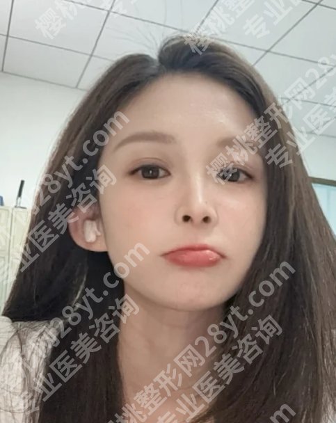 申霄医生做双眼皮修复怎么样？审美独特、技术成稳！