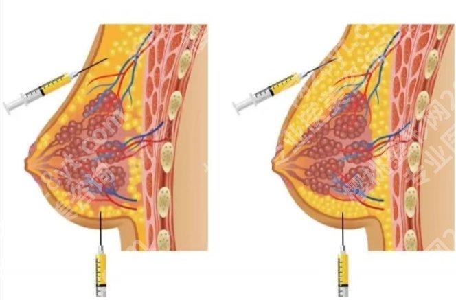 长沙做缩胸手术多少钱？医院隆胸项目详细介绍！点击收藏