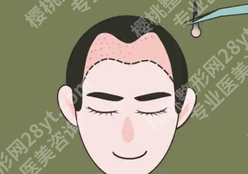 深圳北大医院植发价格是多少?低至10000元起、实力医生公布!