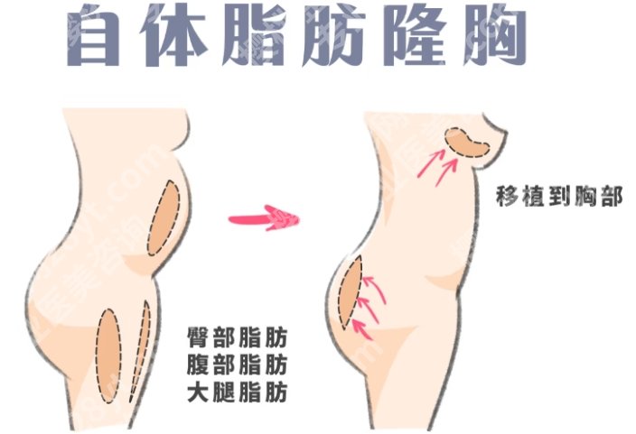 烟台自体脂肪丰胸医院排名更新！医院具体内容详情！