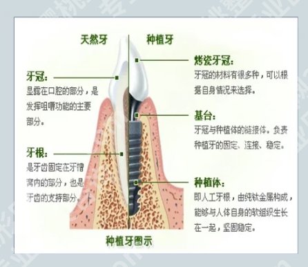 泰州牙齿种植哪家好？医院详细介绍\项目具体信息！