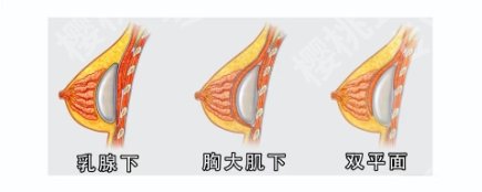徐州哪个医院隆胸好?医院名单详情揭秘!码住不亏!