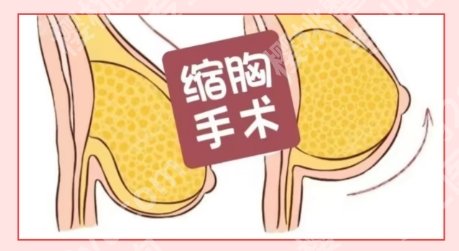 长沙医院做缩胸需要多少钱？低至13380元起|价格表公布！