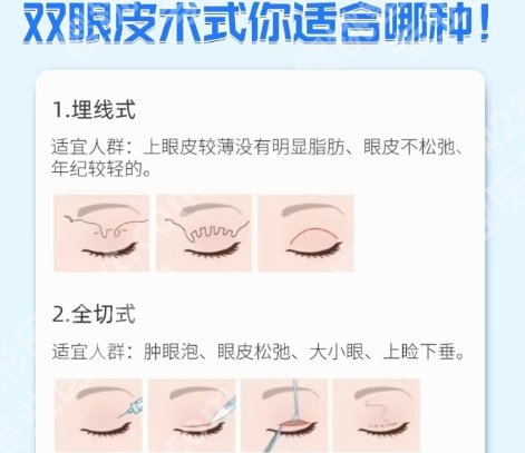 泉州割双眼皮三甲医院名单！医院技术实力雄厚！