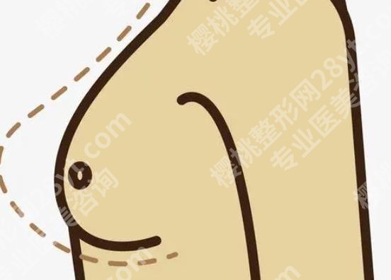 广州玻尿酸丰胸要多少钱？当地胸部整形热门医院推荐！