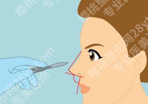 朱飞医生取鼻子怎么样啊？风格技术评析！戳进来看