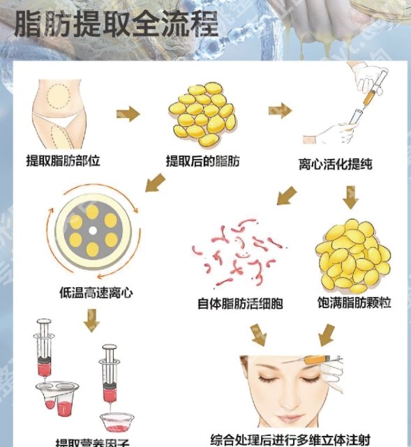 上海华美自体脂肪填充怎么样？做填充案例及术后tips分享！