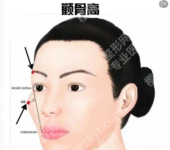 华西医院颧骨手术多少钱？医院技术优势分析！